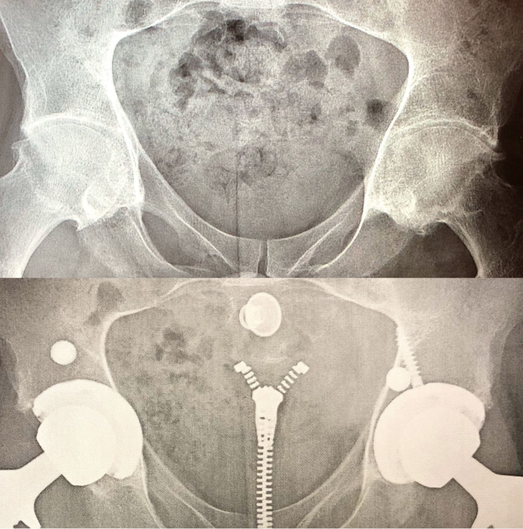 X-ray images of hips before and after hip replacement surgery