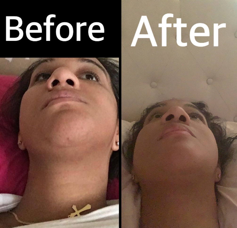 A before and after photo of Nadine's jaw, once crooked, is now corrected